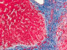 Trichrome Stain- Liver